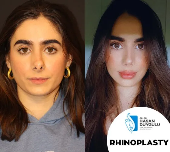 Revision Rhinoplasty in Turkey
