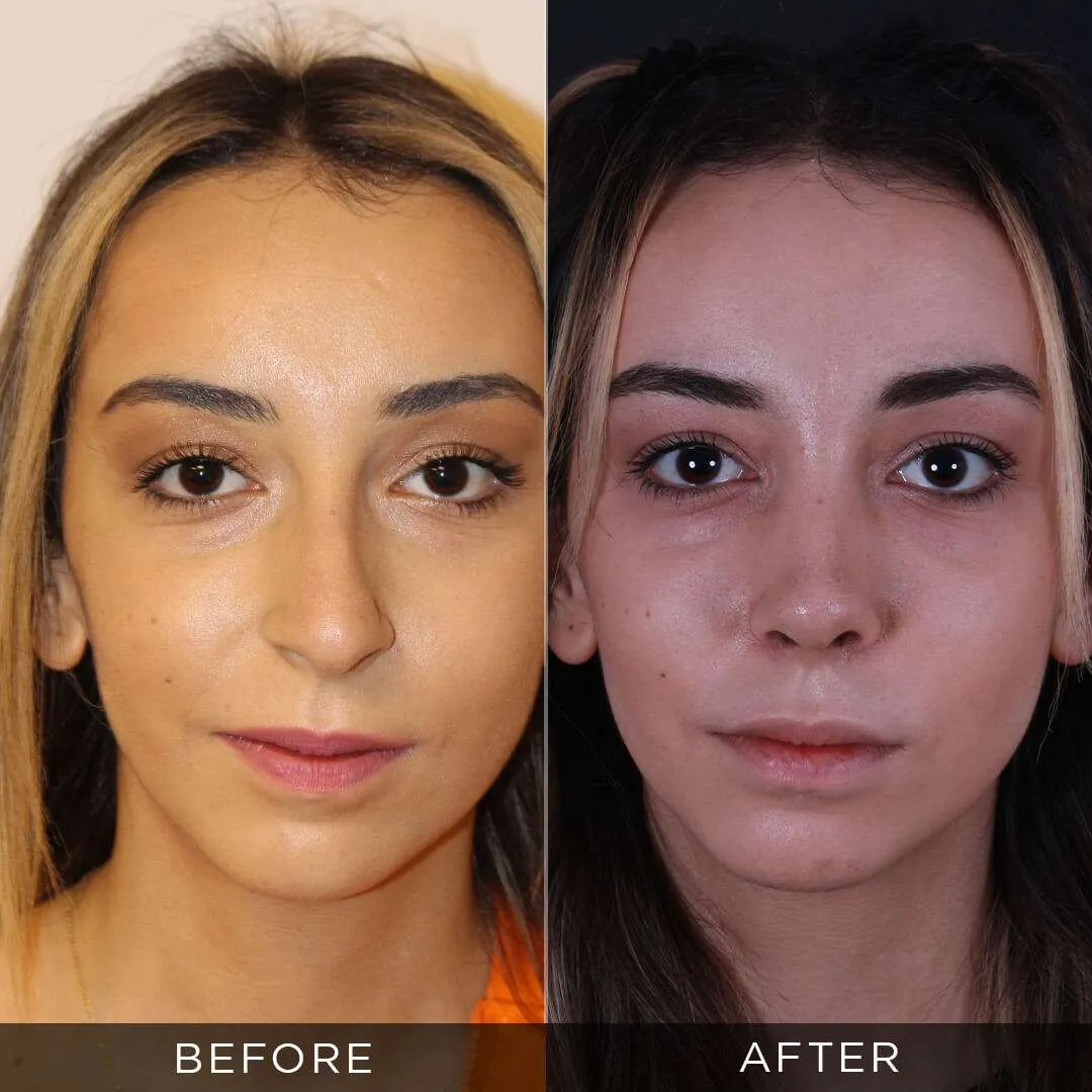 female rhinoplasty at the age of 23 in turkey