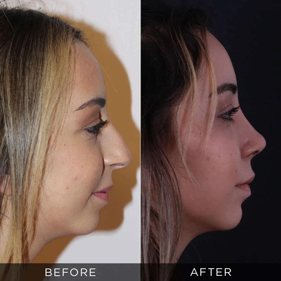 23 year old woman before and after rhinoplasty