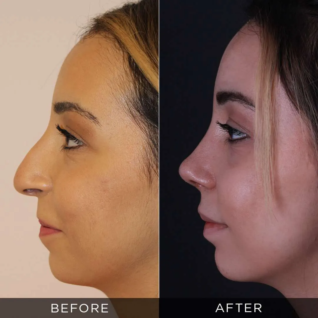 3 months after rhinoplasty