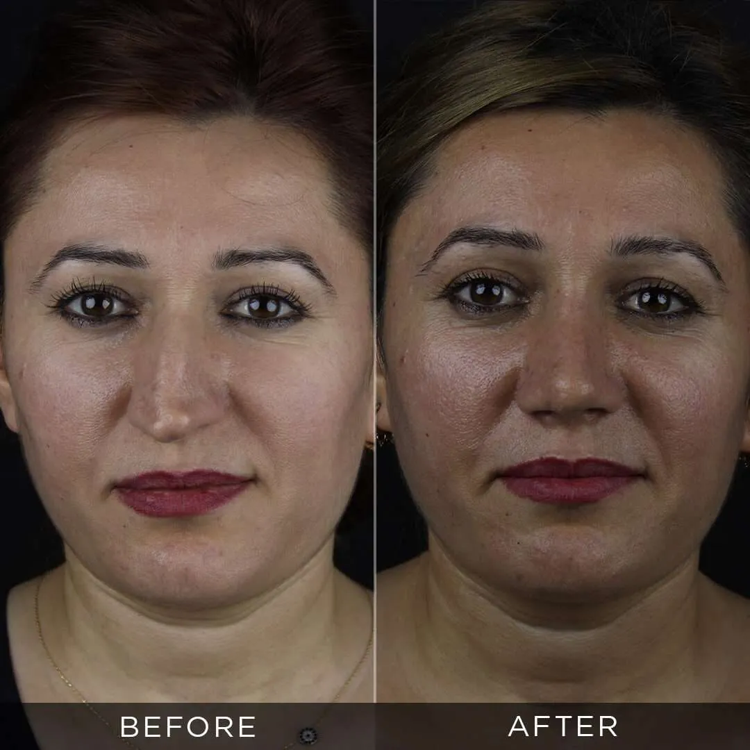 women after rhinoplasty in turkey