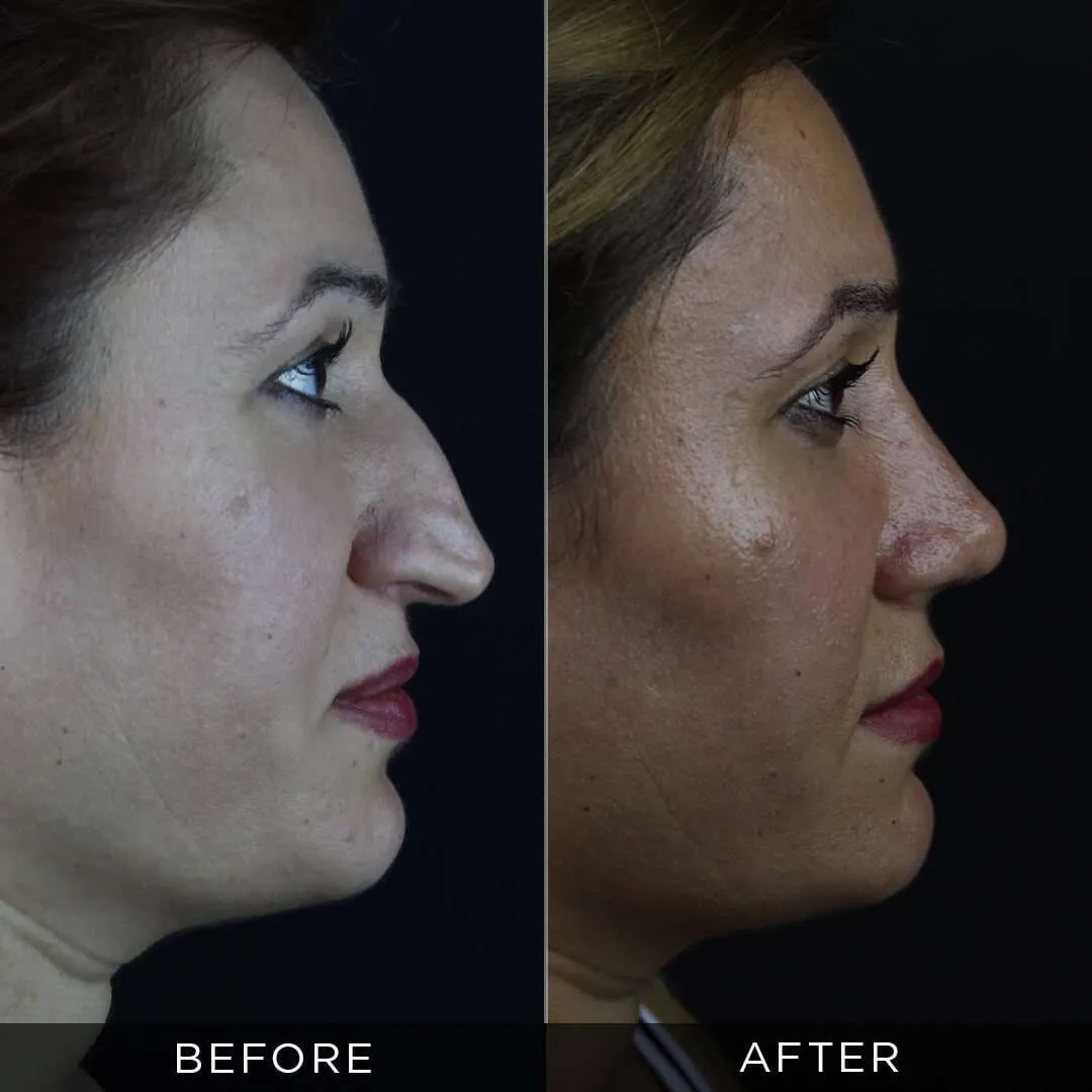 women after rhinoplasty in istanbul