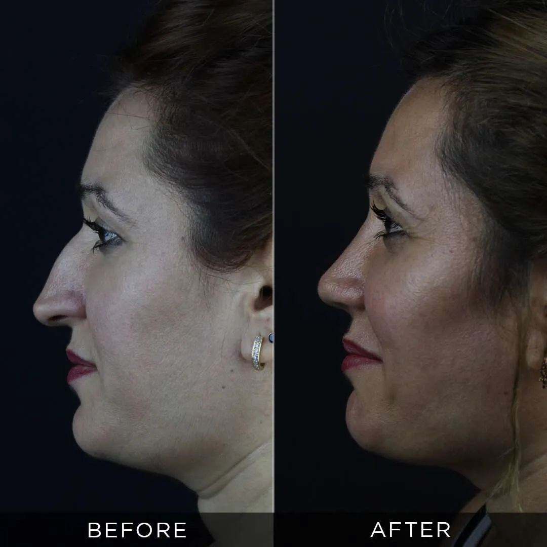 one year after women rhinoplasty