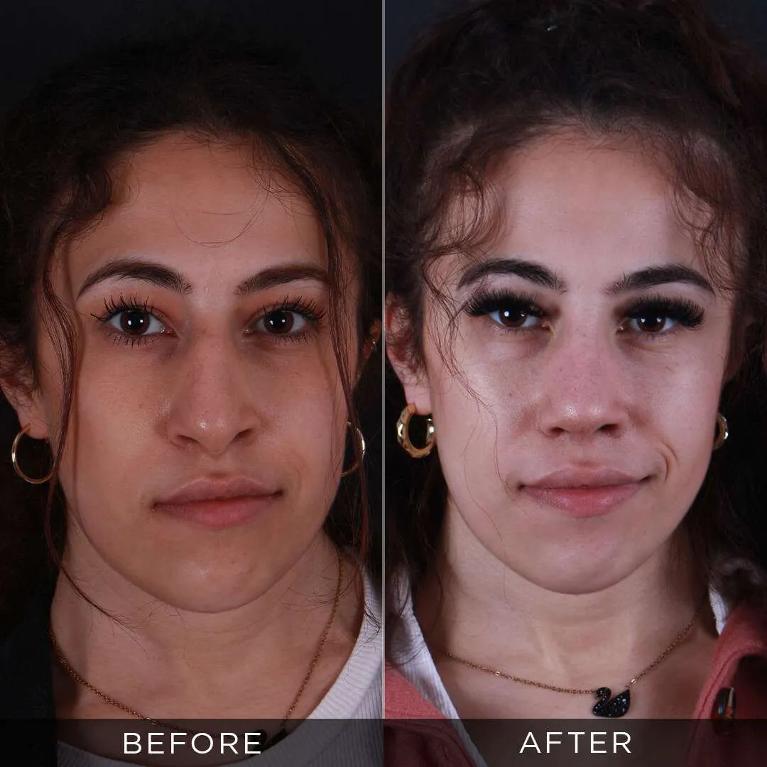 22 year old woman before and after rhinoplasty