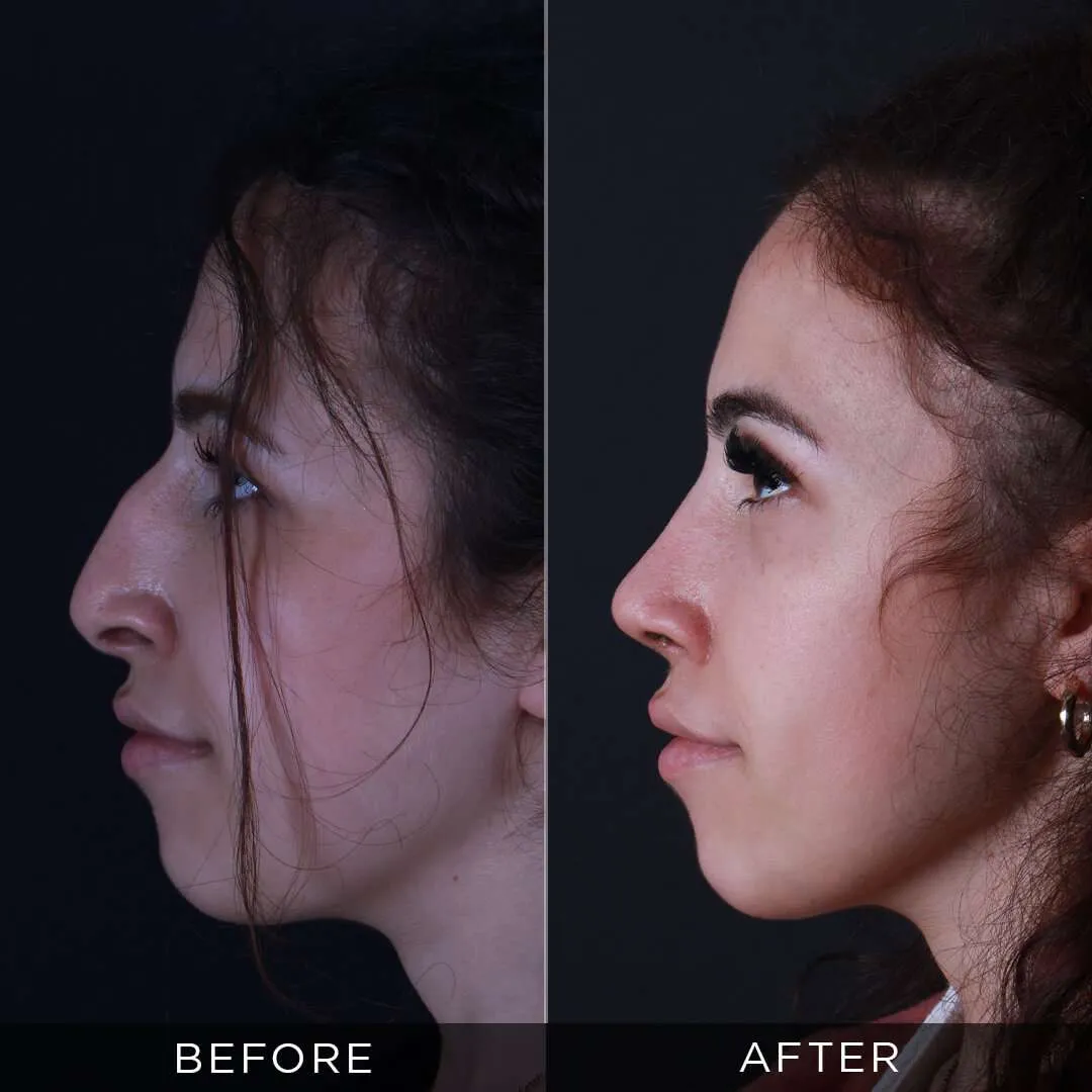8 months post op rhinoplasty