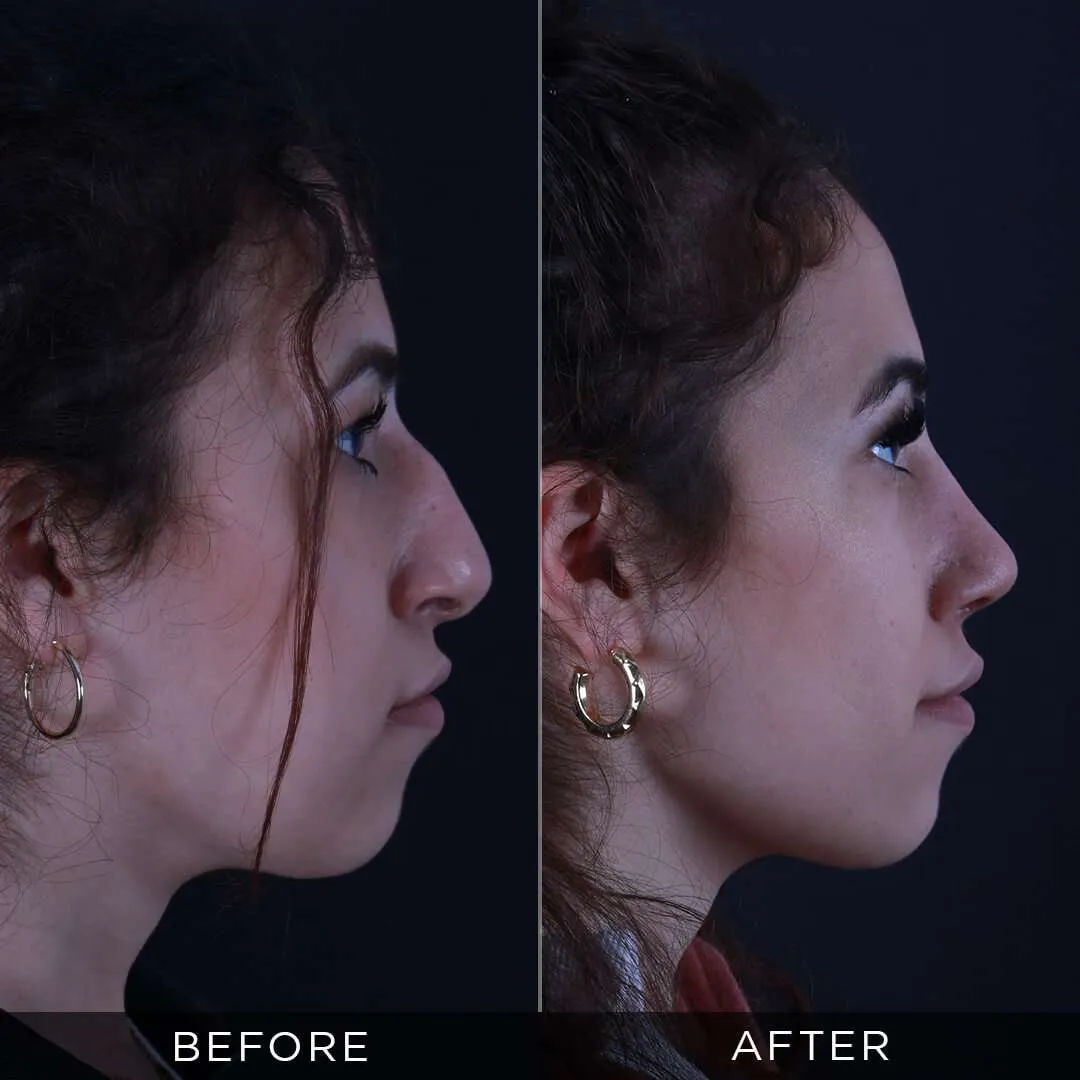piezzo female rhinoplasty in turkey