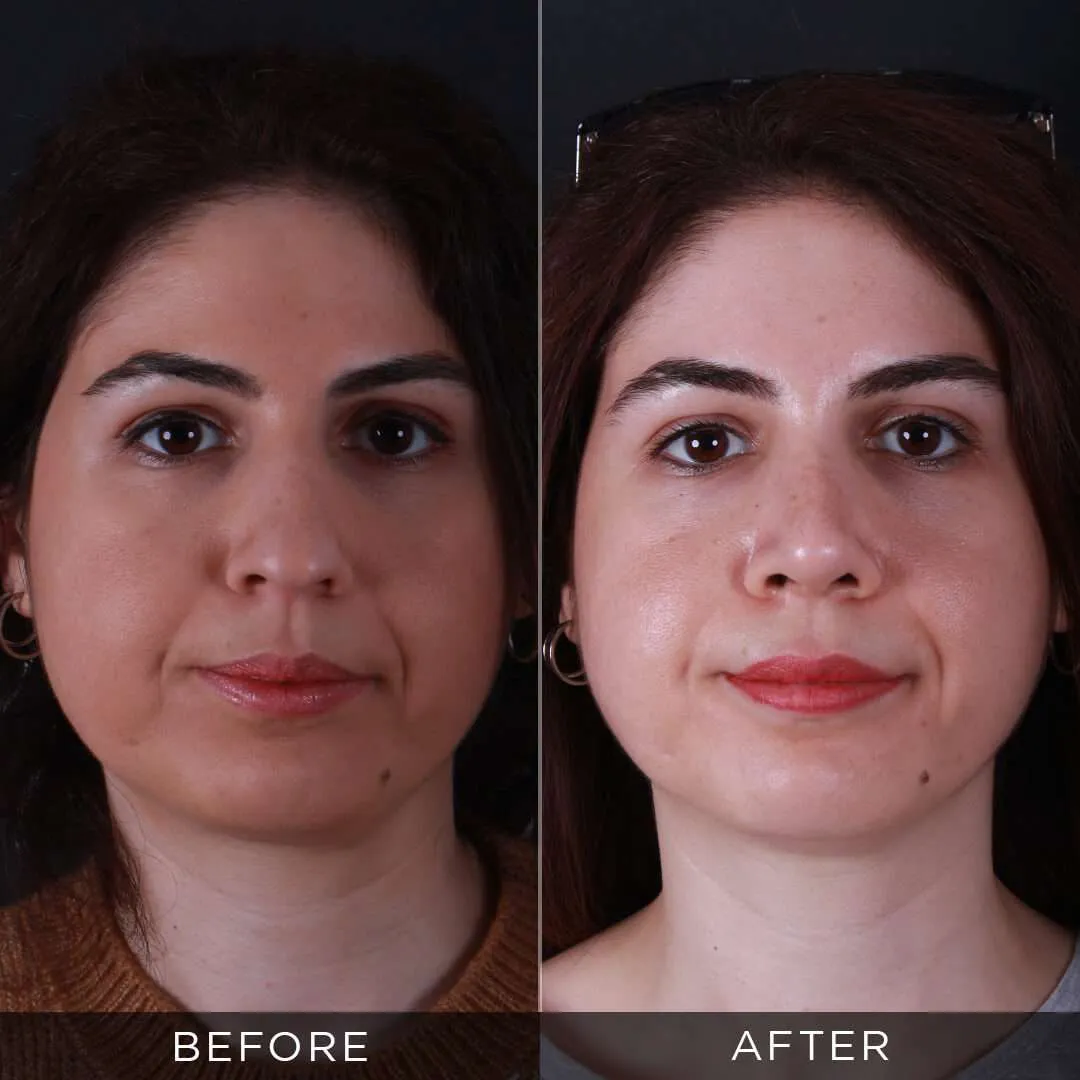 Rhinoplasty for 34 year old woman in Istanbul