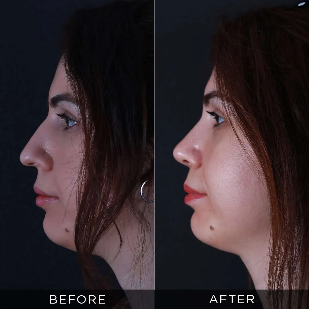 Rhinoplasty for 34 year old women in Turkey