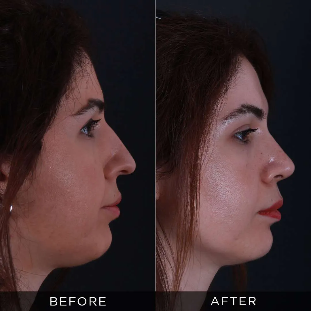 female rhinoplasty three months after