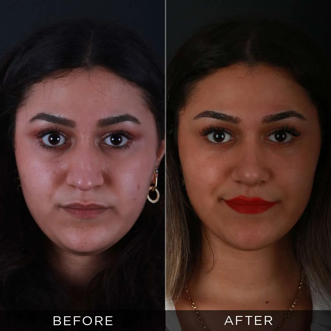 8 months after 26 years old rhinoplasty