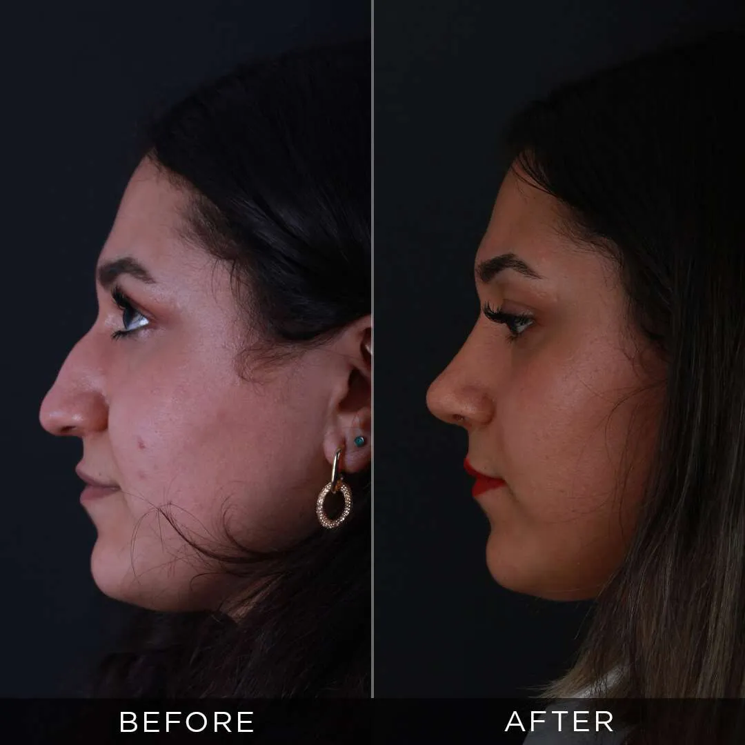 Rhinoplasty in Turkey at the age of 26