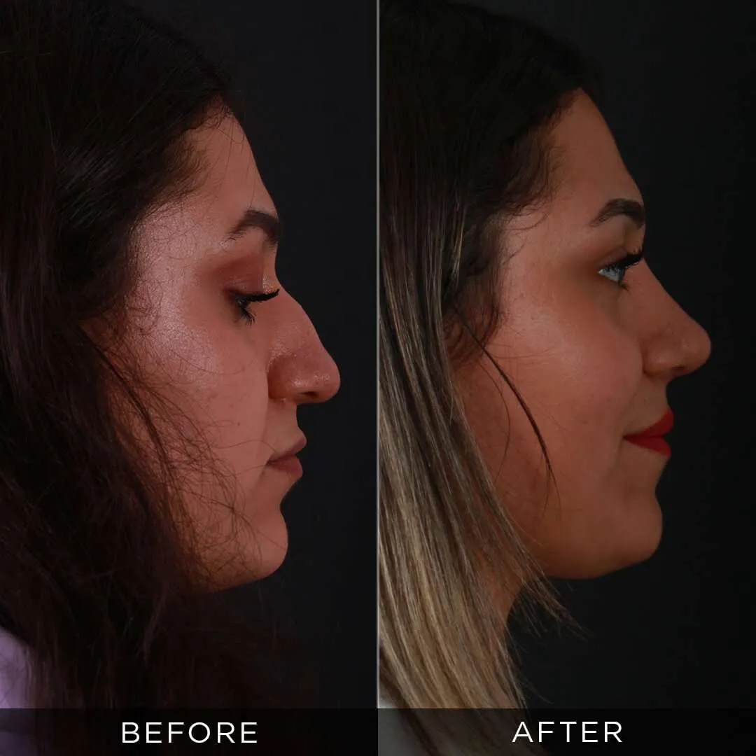26 year old woman before and after rhinoplasty