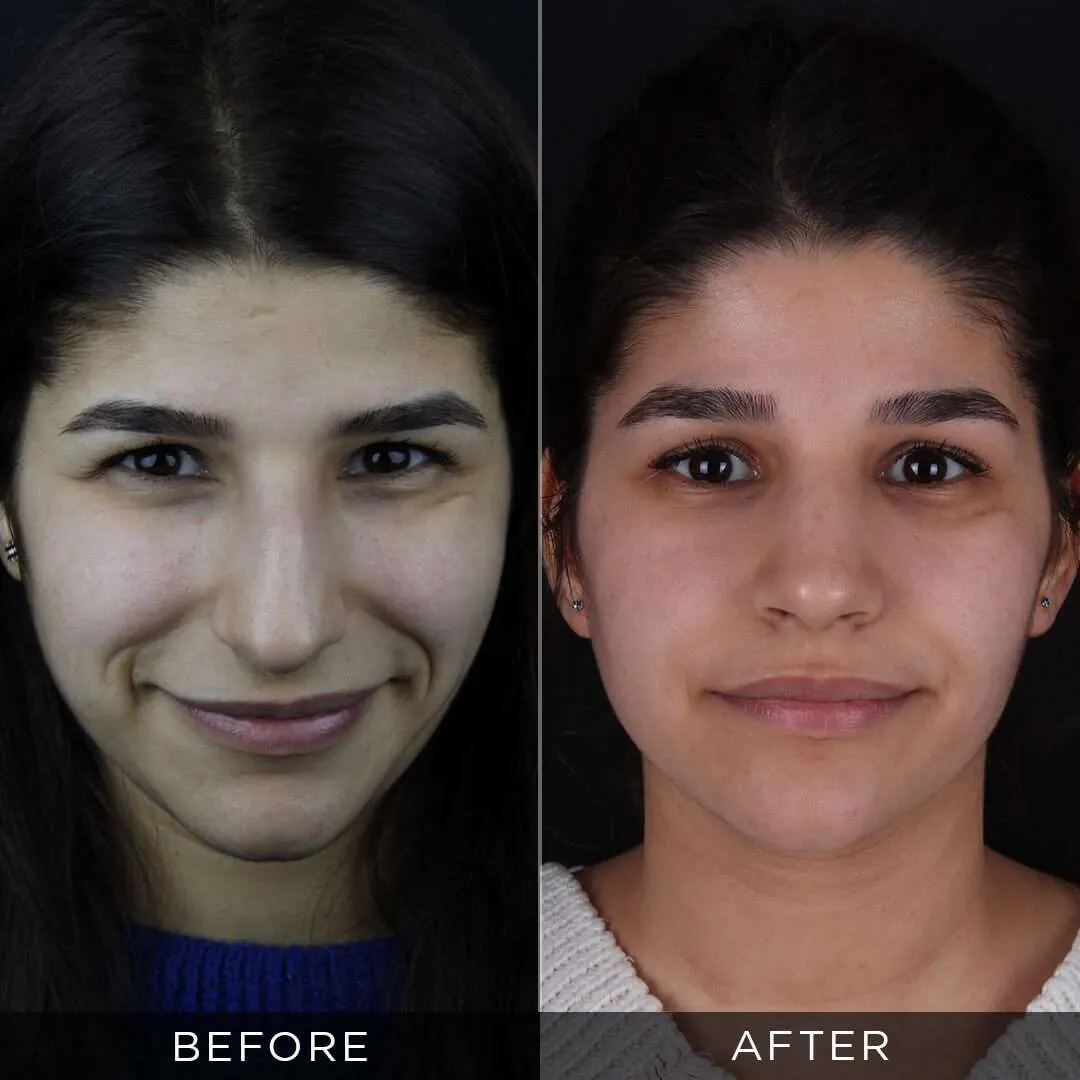 female rhinoplasty in istanbul