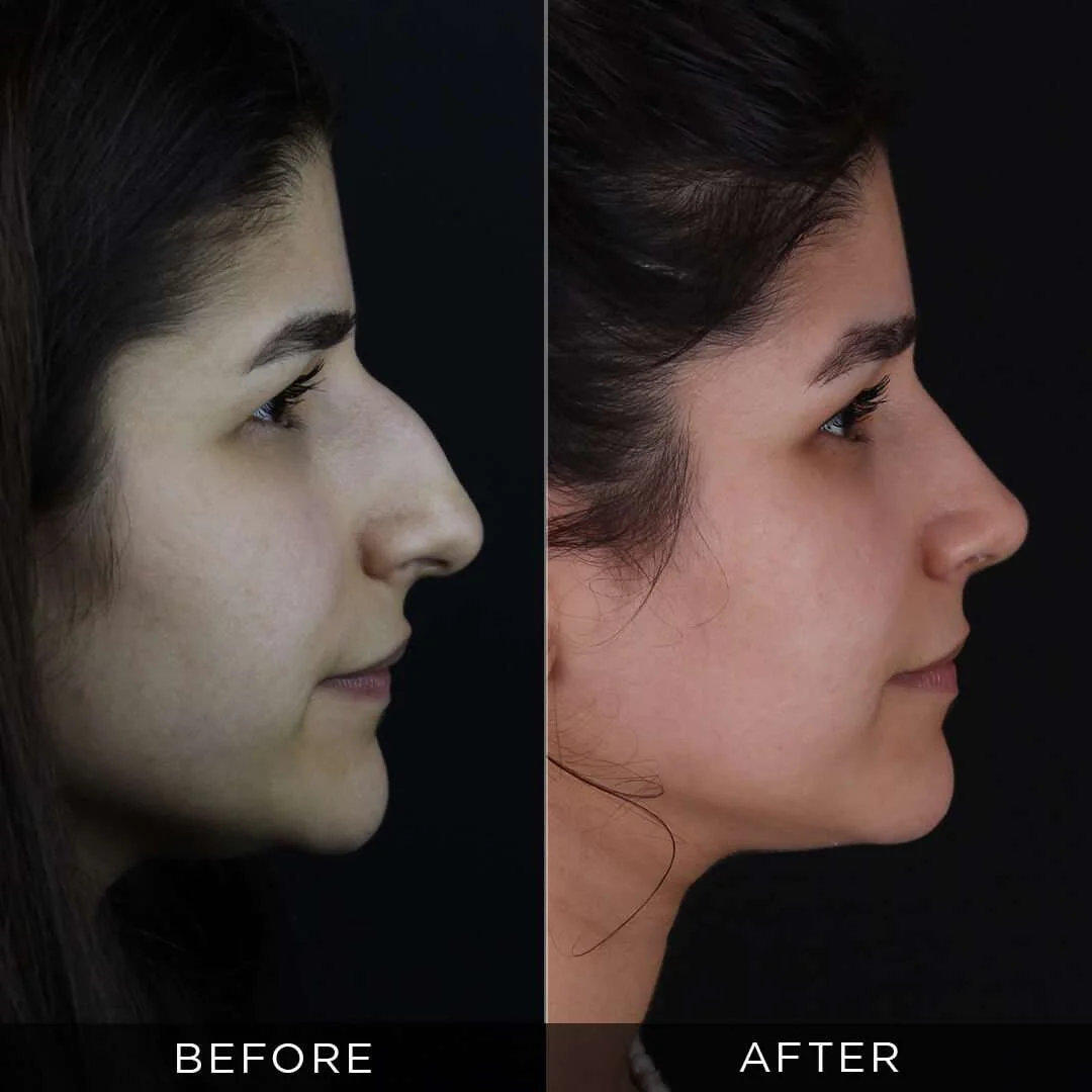 female rhinoplasty in turkey 26 years old