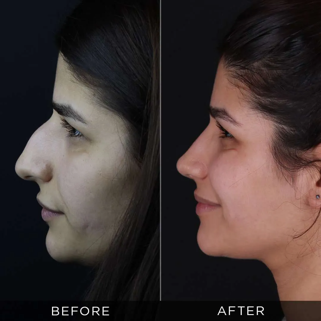 female rhinoplasty 26 years old