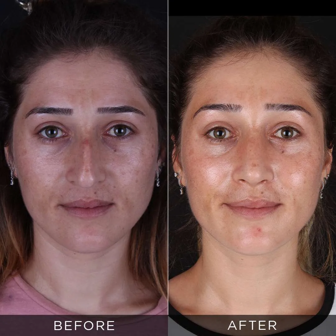 rhinoplasty for 33 year old women in turkey