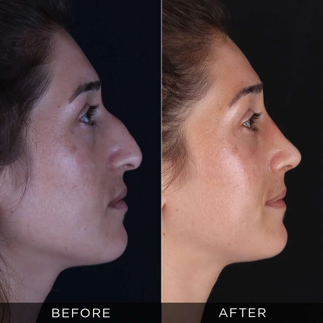 rhinoplasty for women 33 years old in istanbul