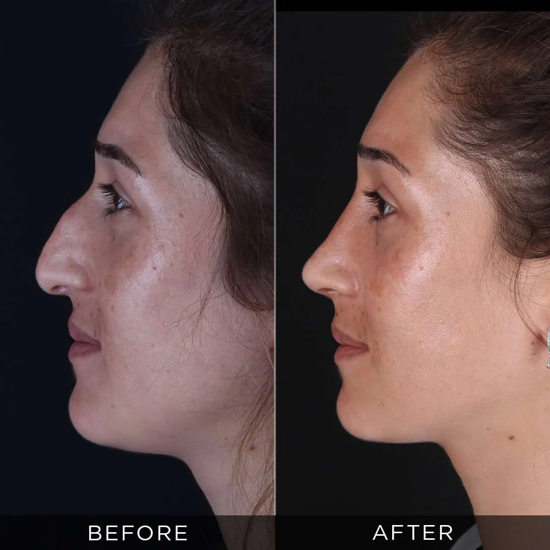 3 weeks after rhinoplasty