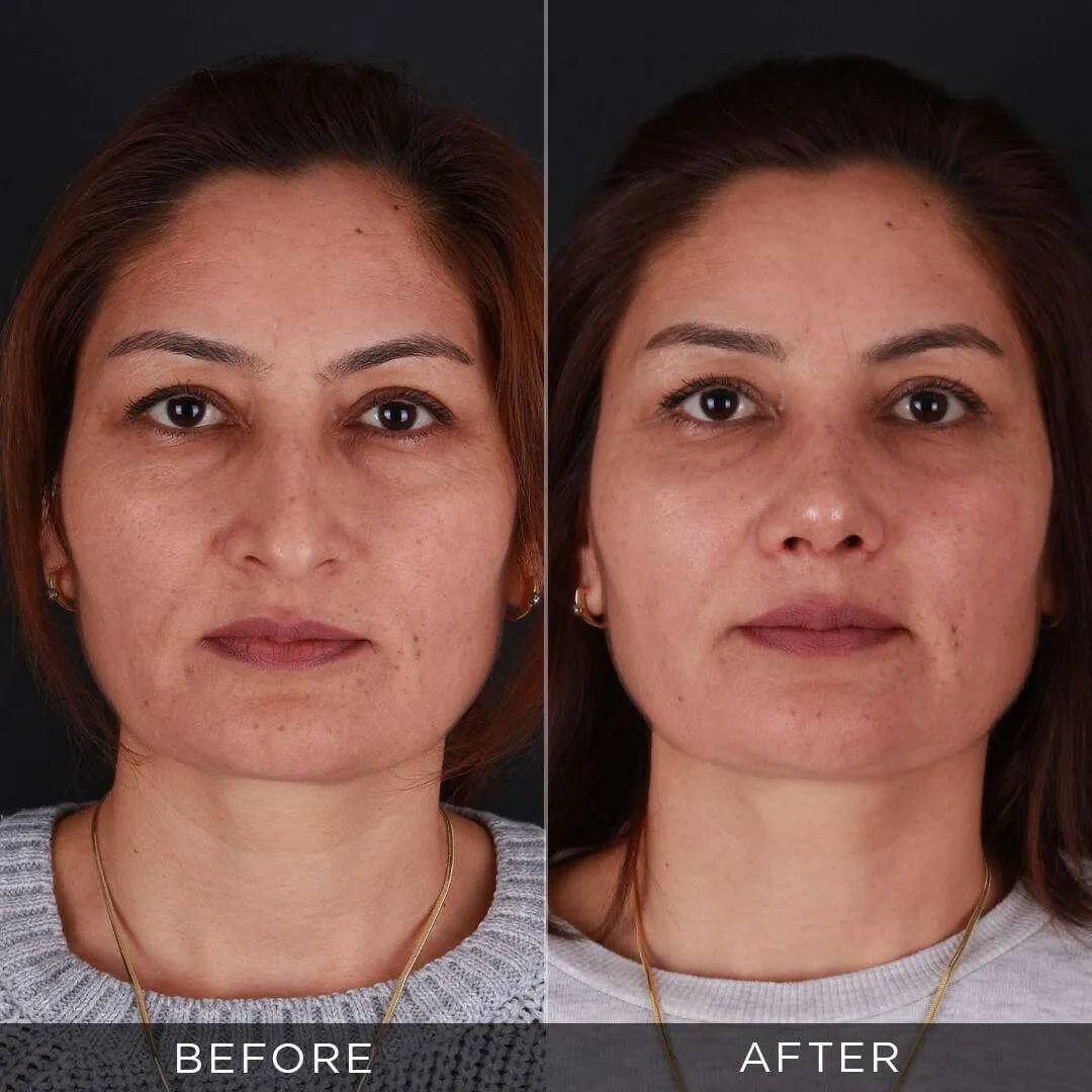 rhinoplasty for women 34 years old in istanbul