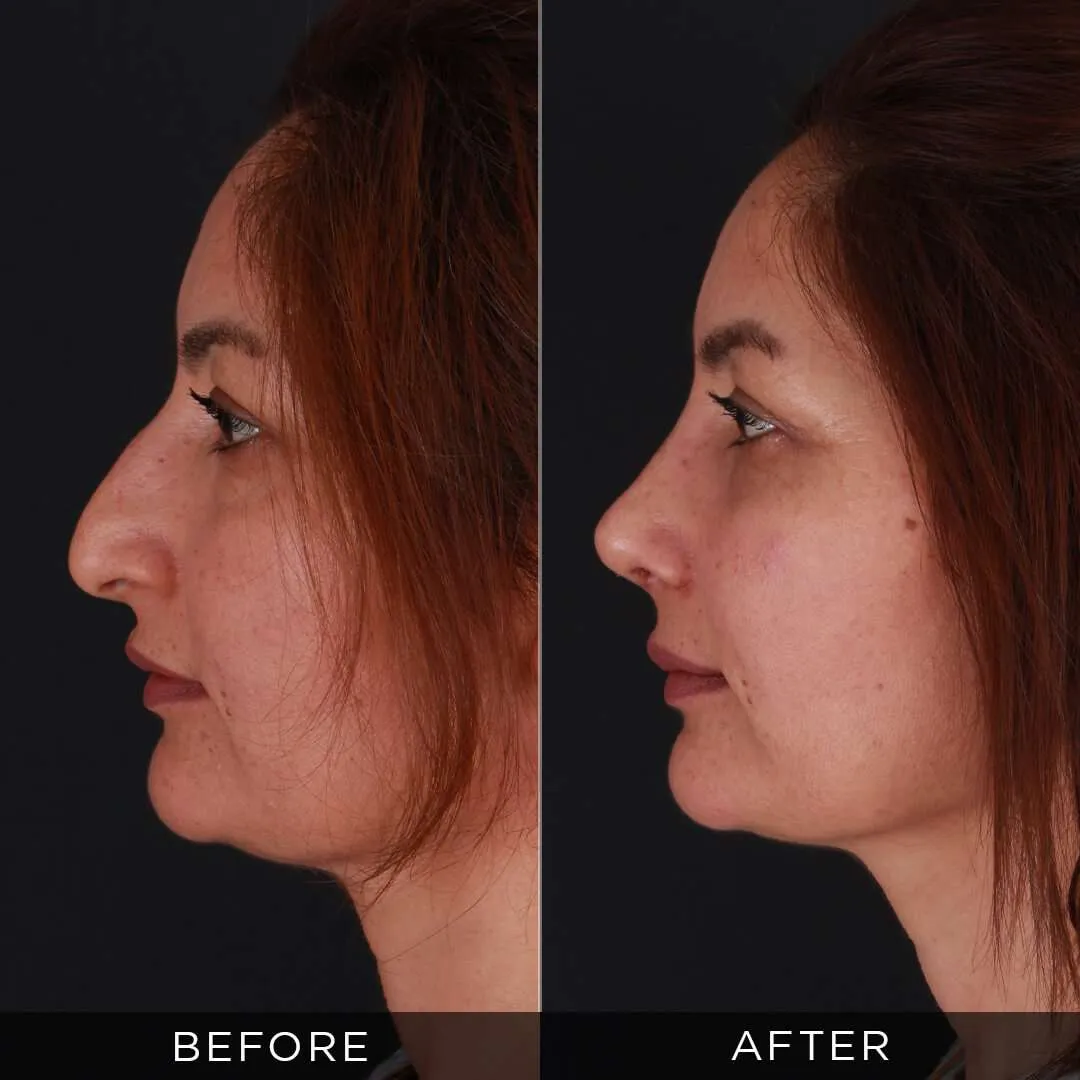 rhinoplasty for women 34 years old in turkey