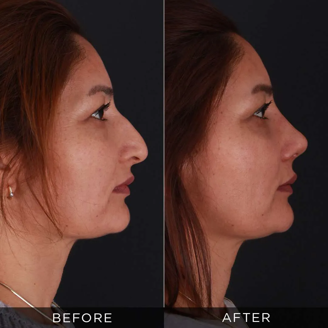 woman one month after rhinoplasty