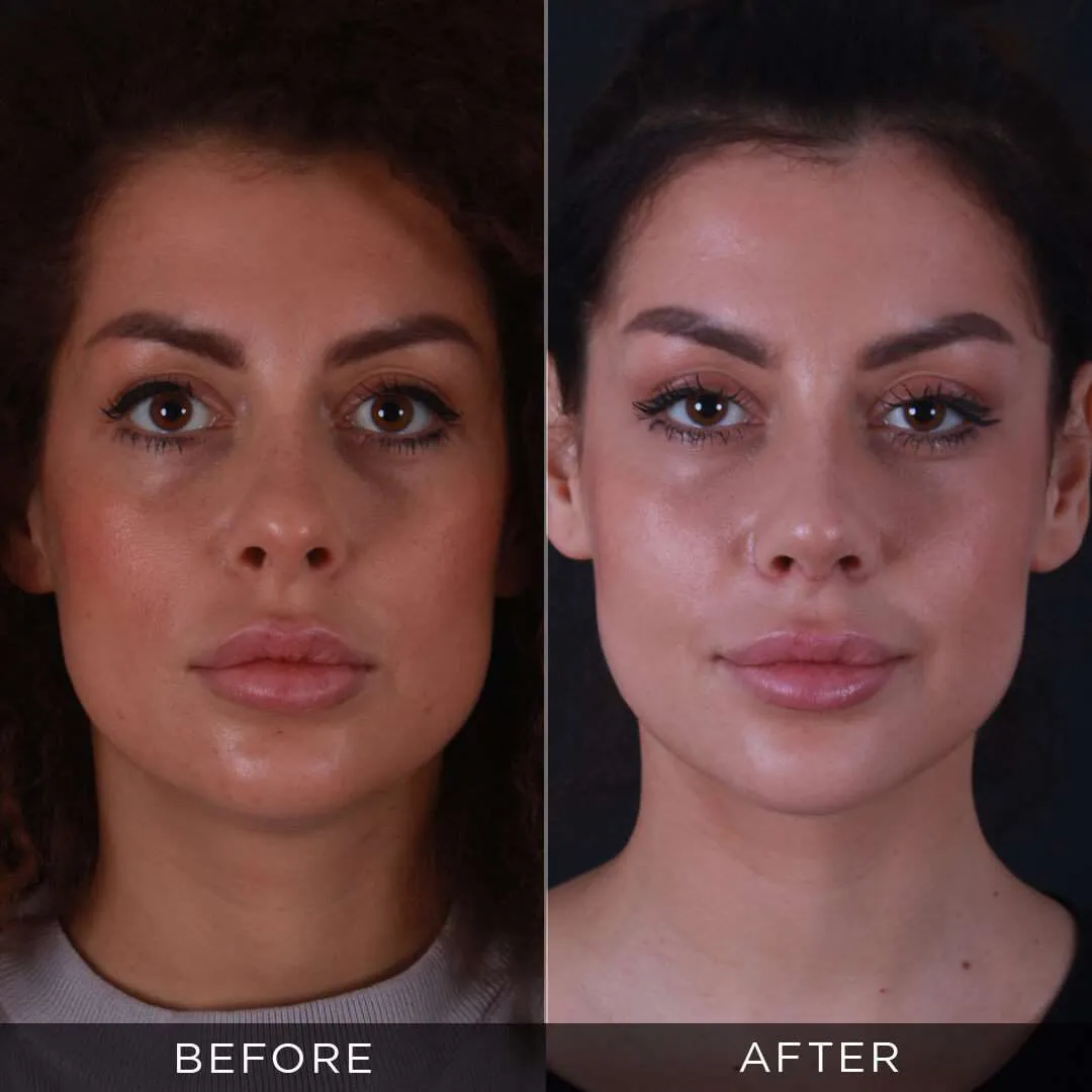 rhinoplasty for women 29 years old in istanbul