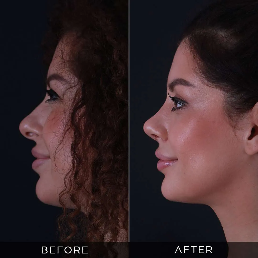 29 years 6 months after rhinoplasty
