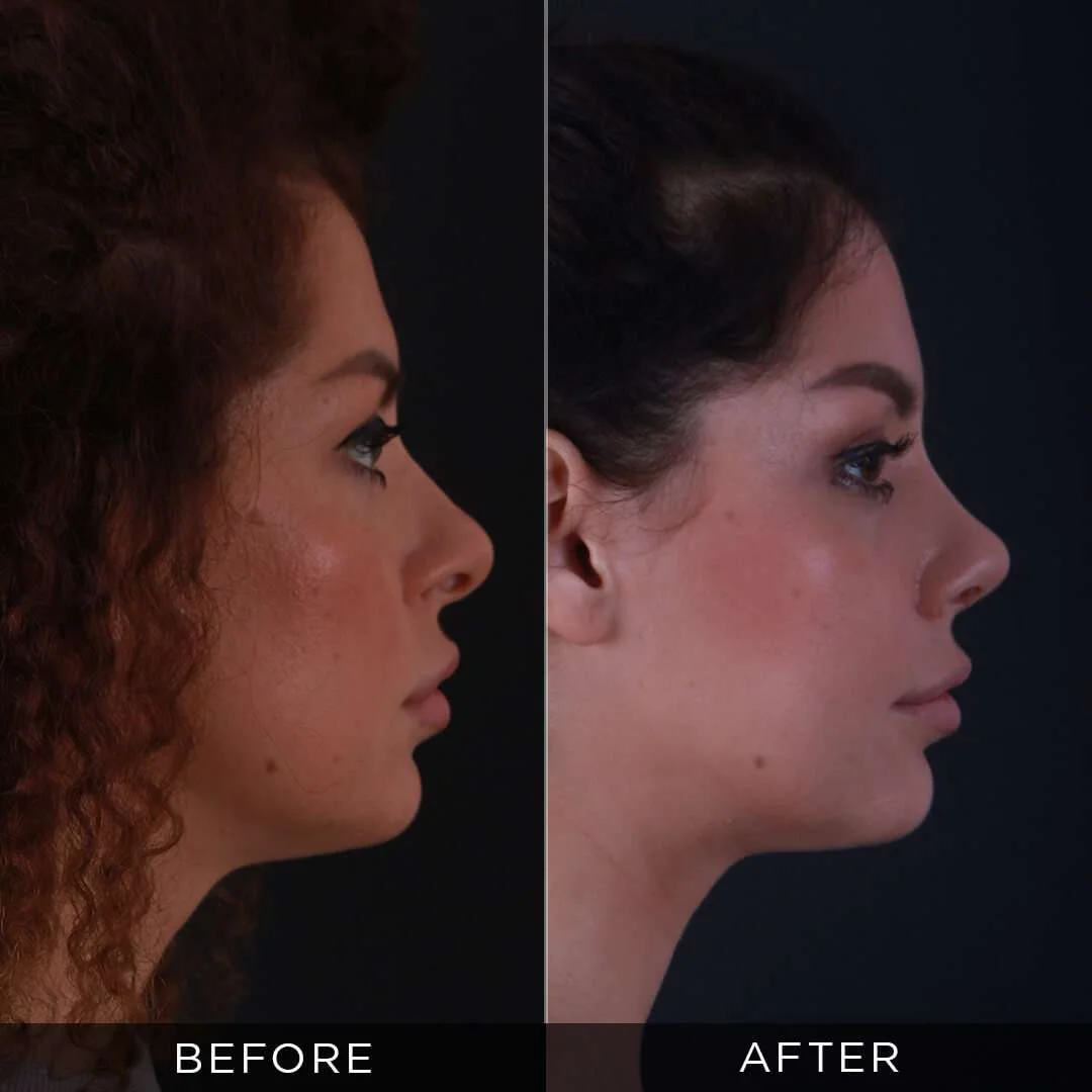woman 6 months after nose surgery