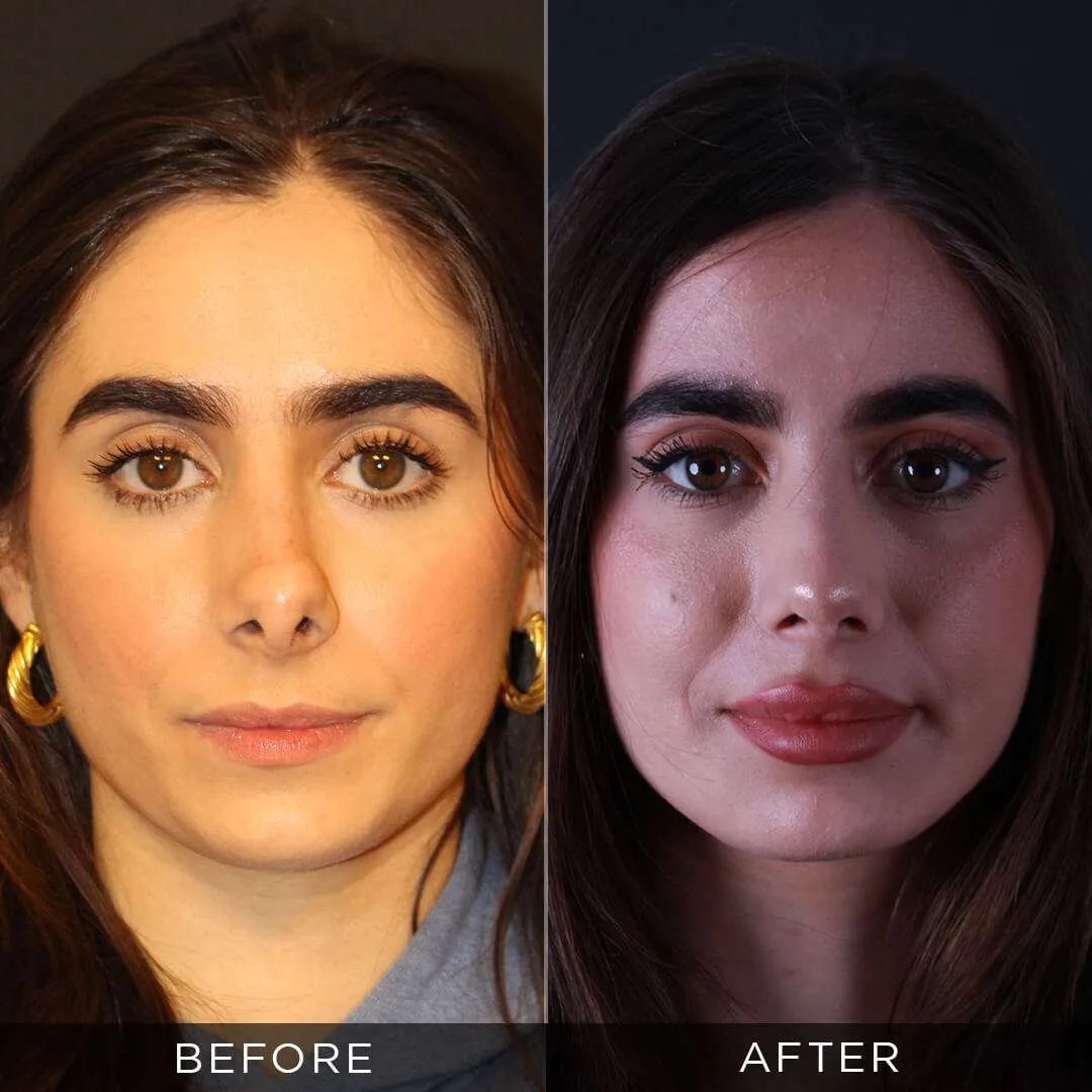 revision rhinoplasty 1 year after