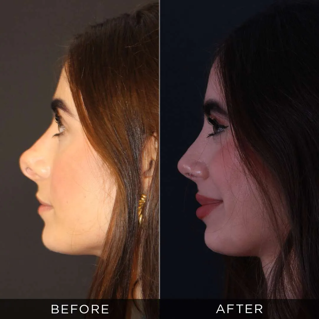 woman 1 year after revision rhinoplasty