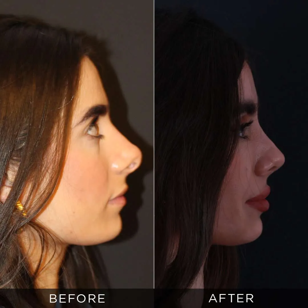 revision rhinoplasty in turkey