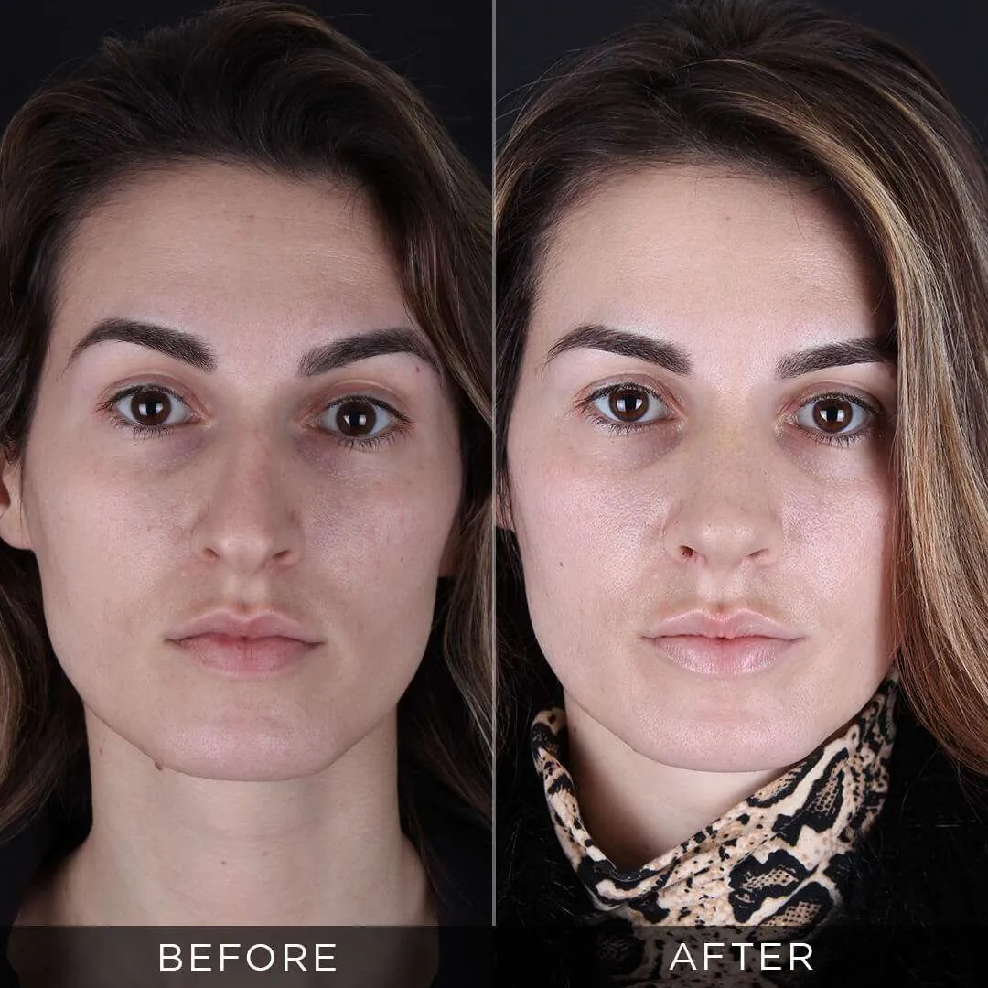 rhinoplasty for women 28 years old in turkey