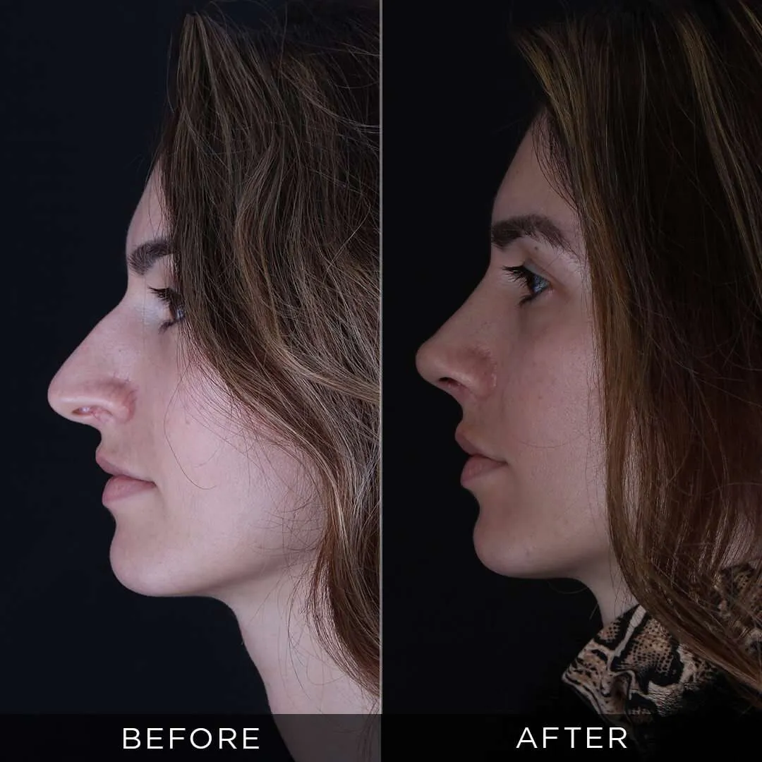 6 months after piezzo rhinoplasty