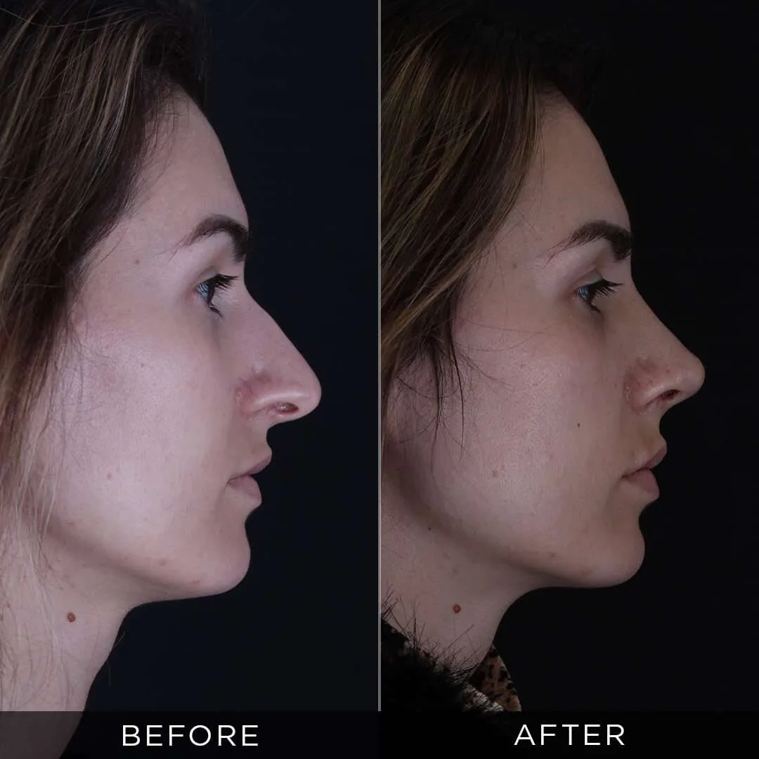 rhinoplasty for female 28 years of age in istanbul