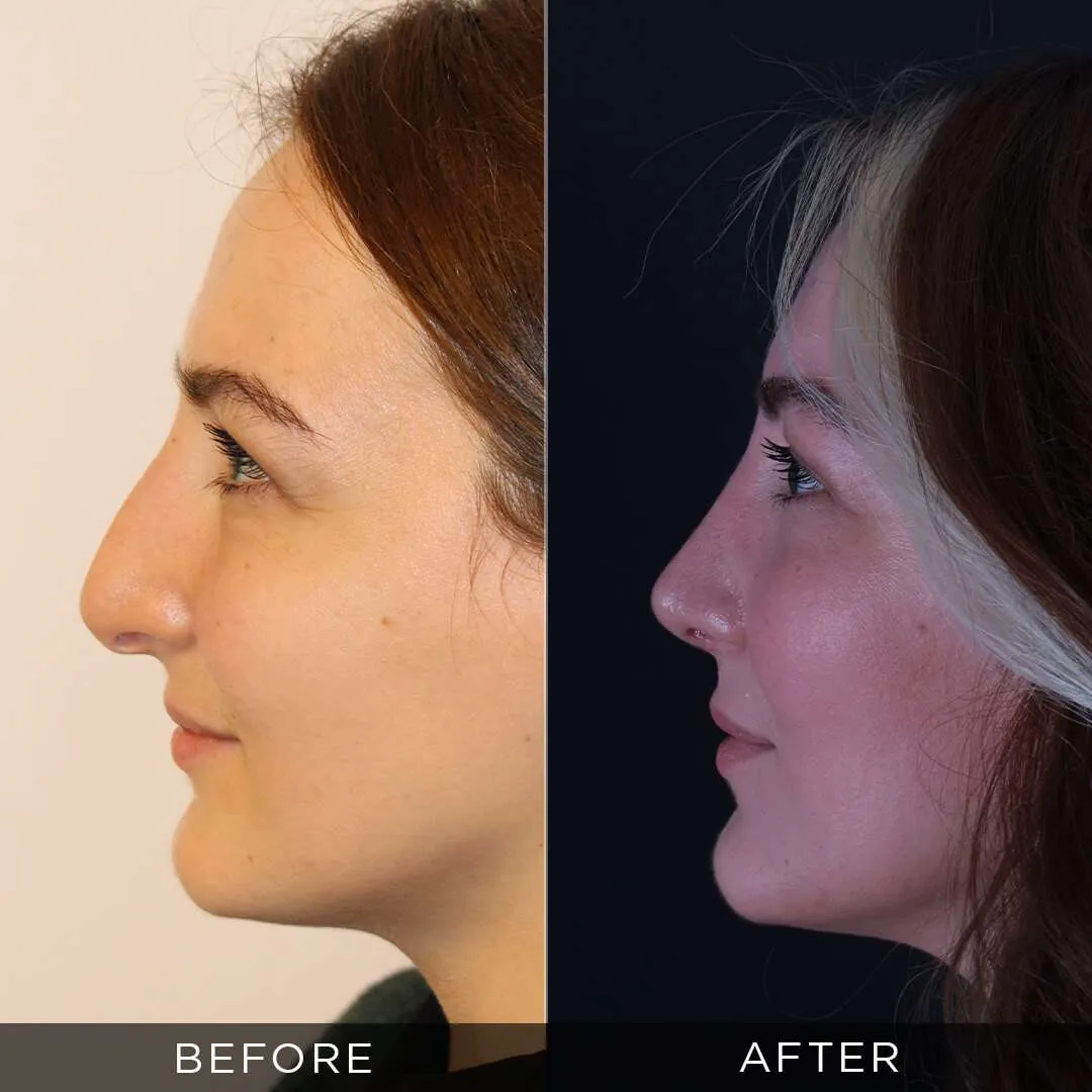 2 years after female rhinoplasty