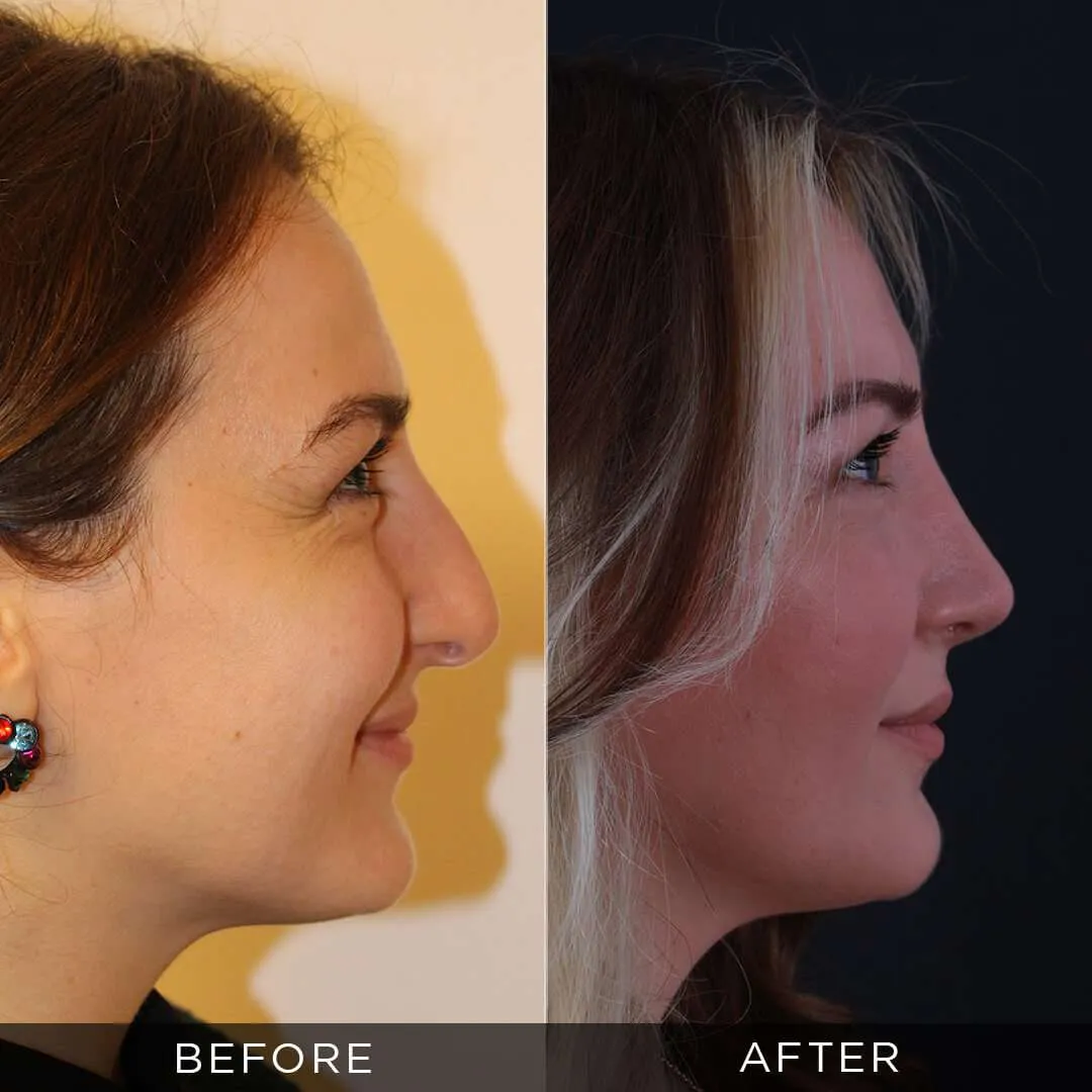 rhinoplasty for women 35 years old in turkey