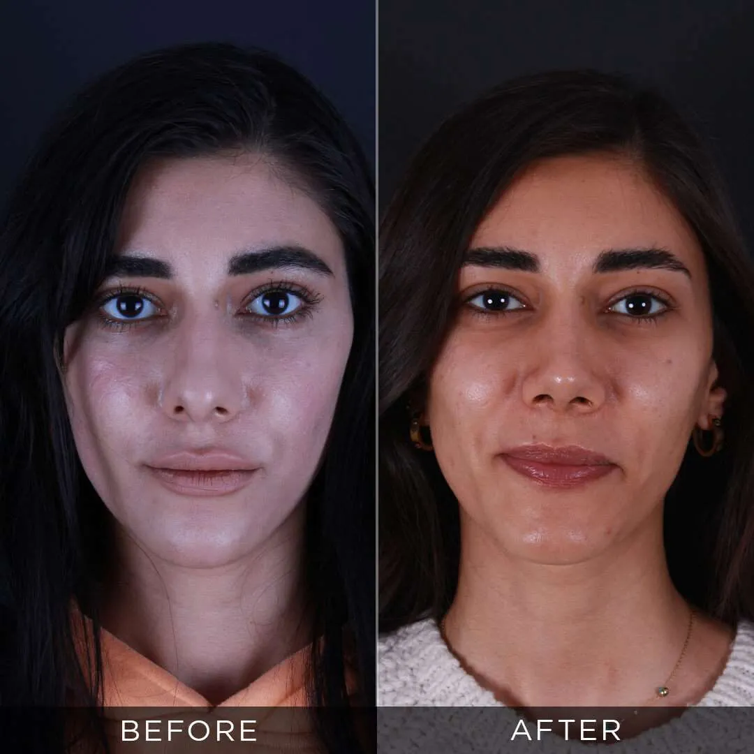 Rhinoplasty Before & After Gallery