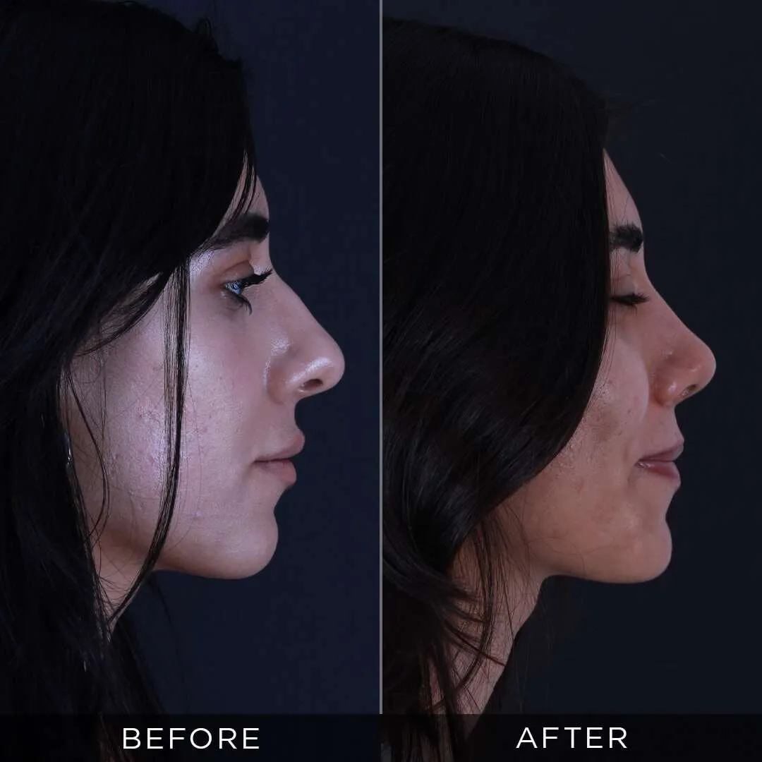 Rhinoplasty Before & After Gallery