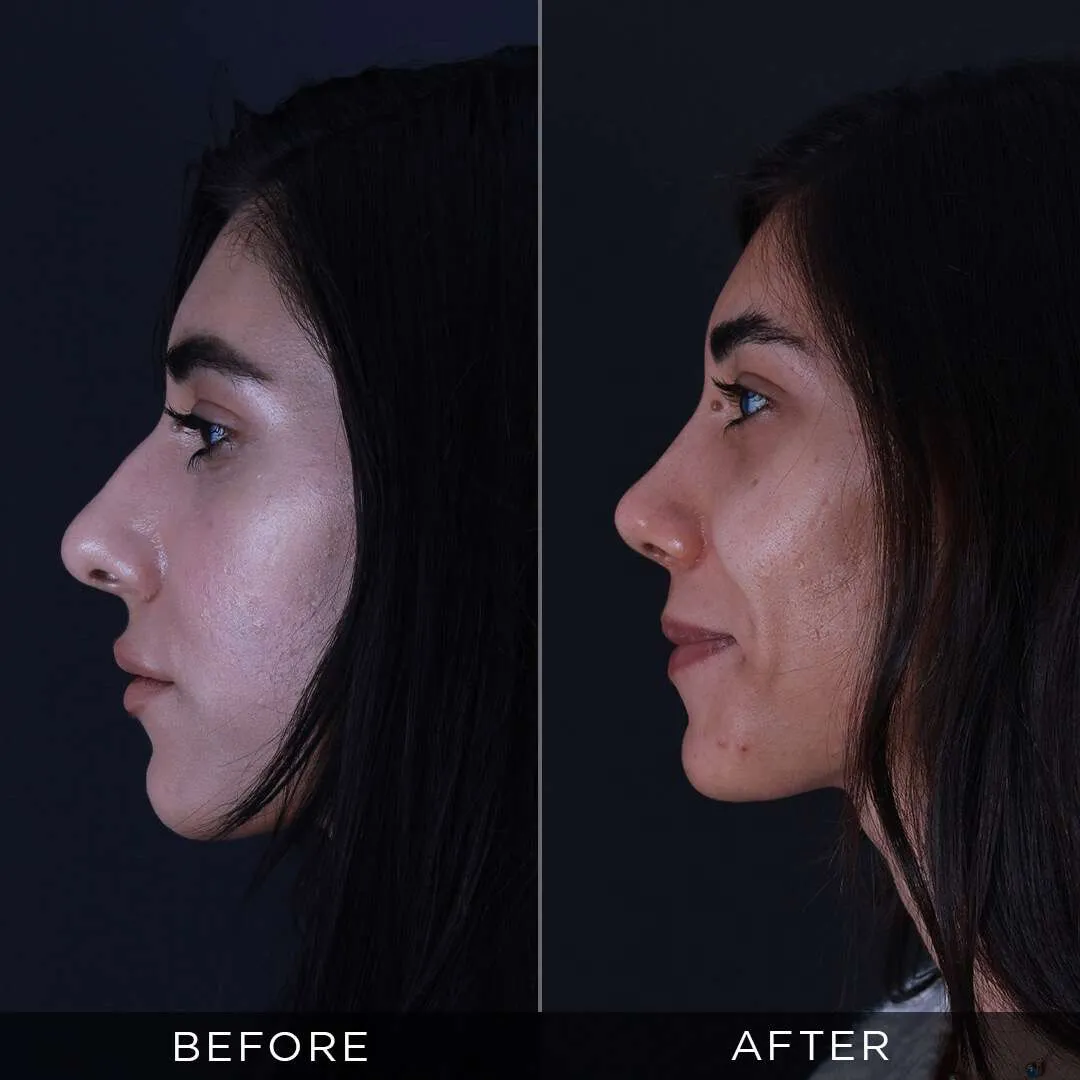 Rhinoplasty Before & After Gallery