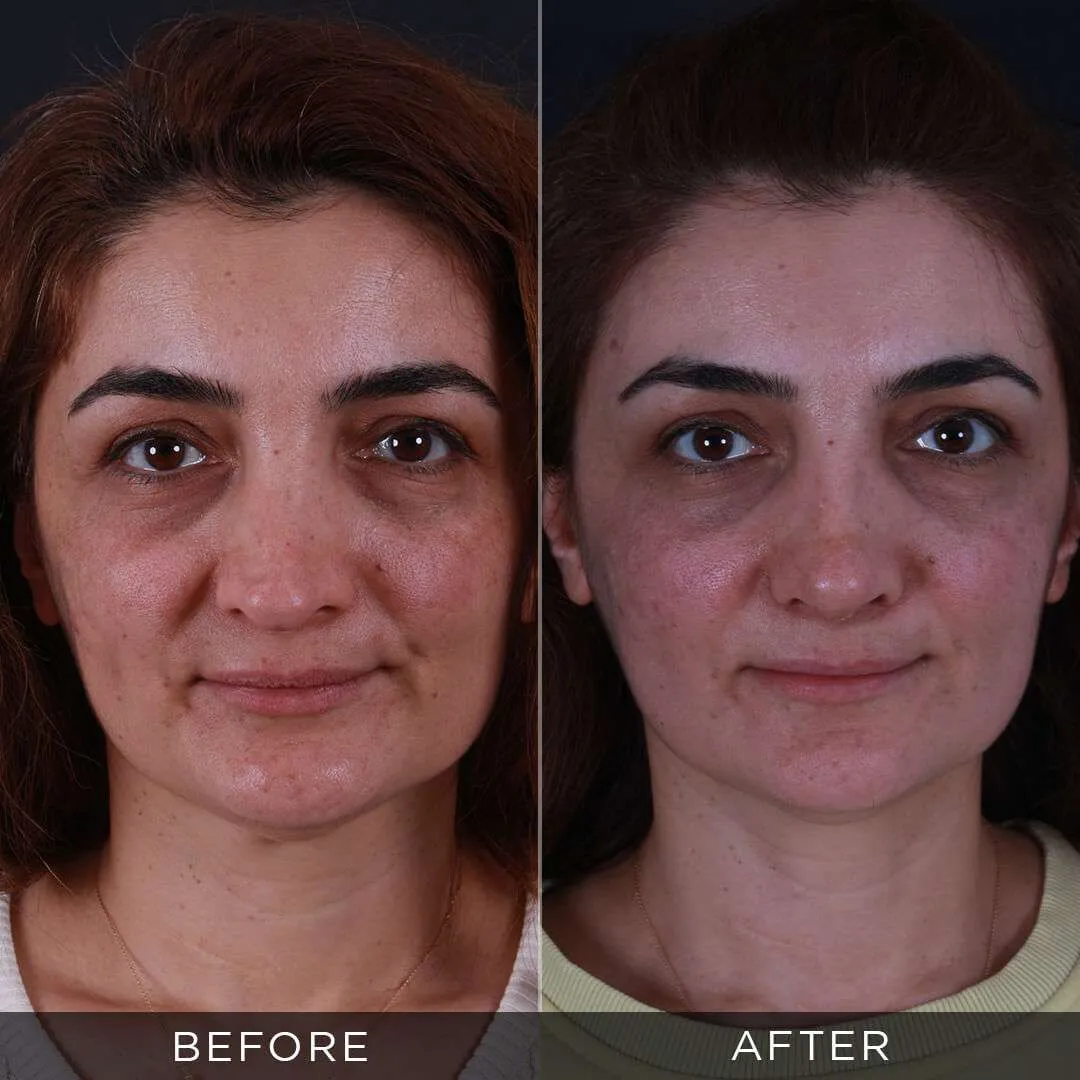 Rhinoplasty Before & After Gallery