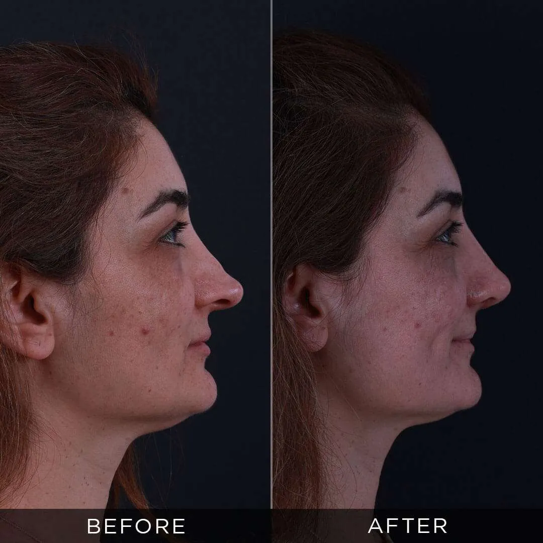 Rhinoplasty Before & After Gallery