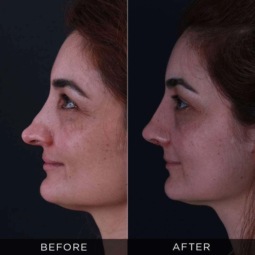 Rhinoplasty Before & After Gallery
