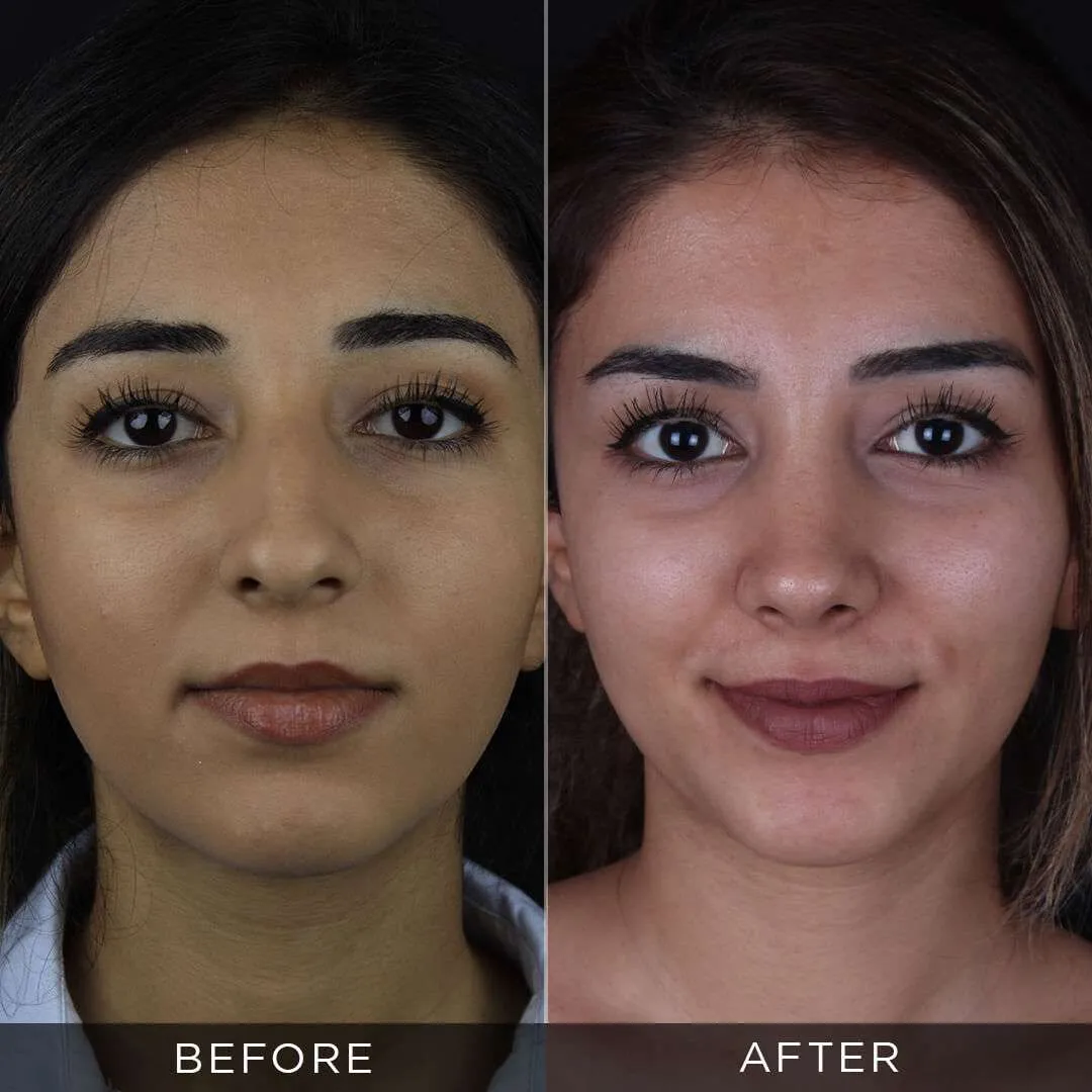 female piezzo rhinoplasty 25 years old