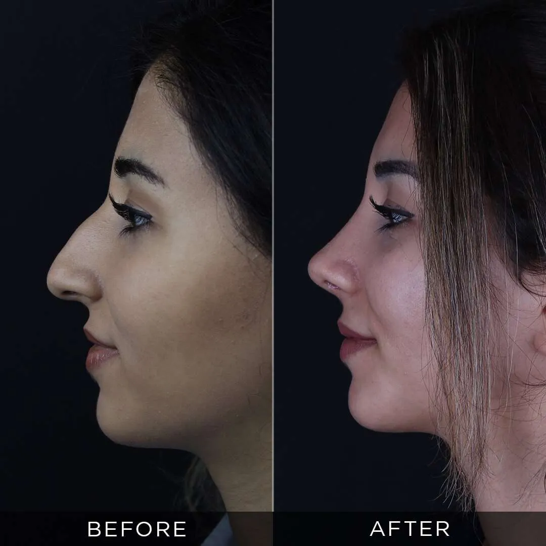 female rhinoplasty 25 years old