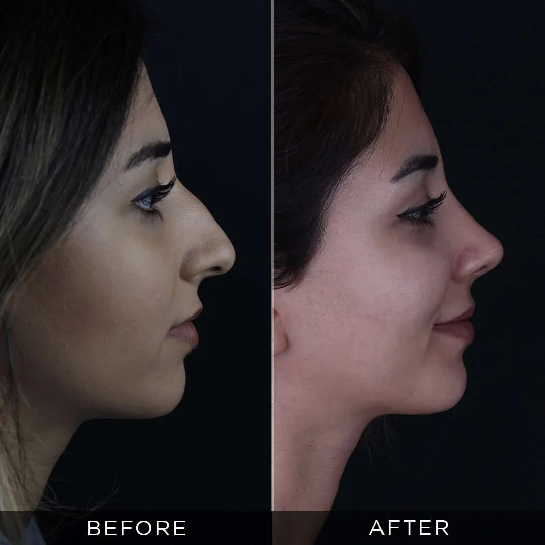 woman 8 months after rhinoplasty