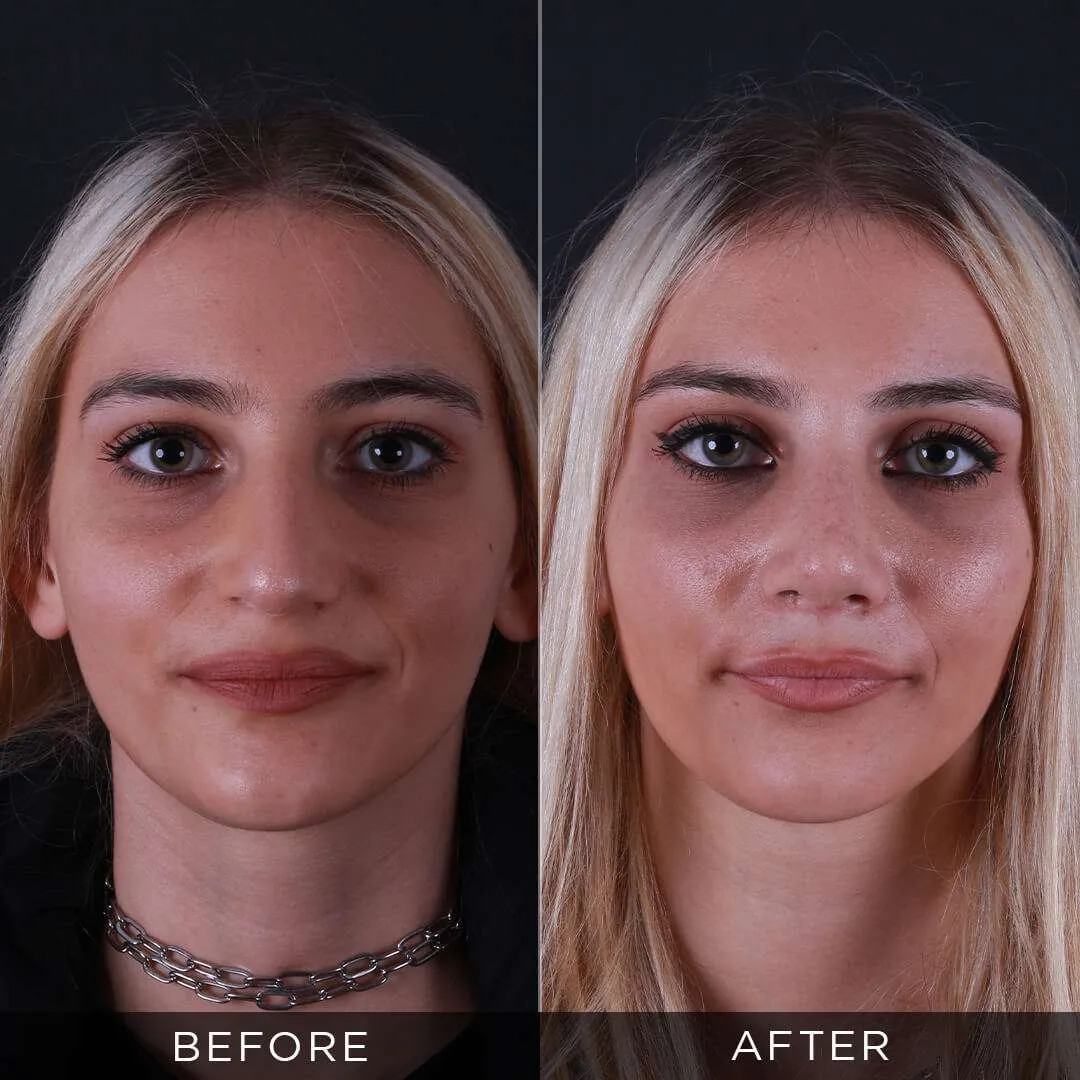 28 year old female rhinoplasty in istanbul