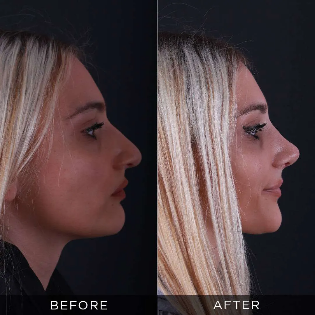 3 weeks after piezzo rhinoplasty