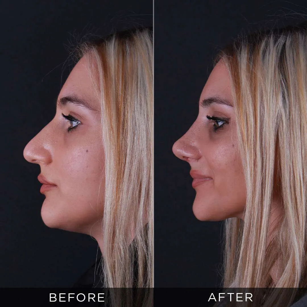 woman 3 weeks after rhinoplasty