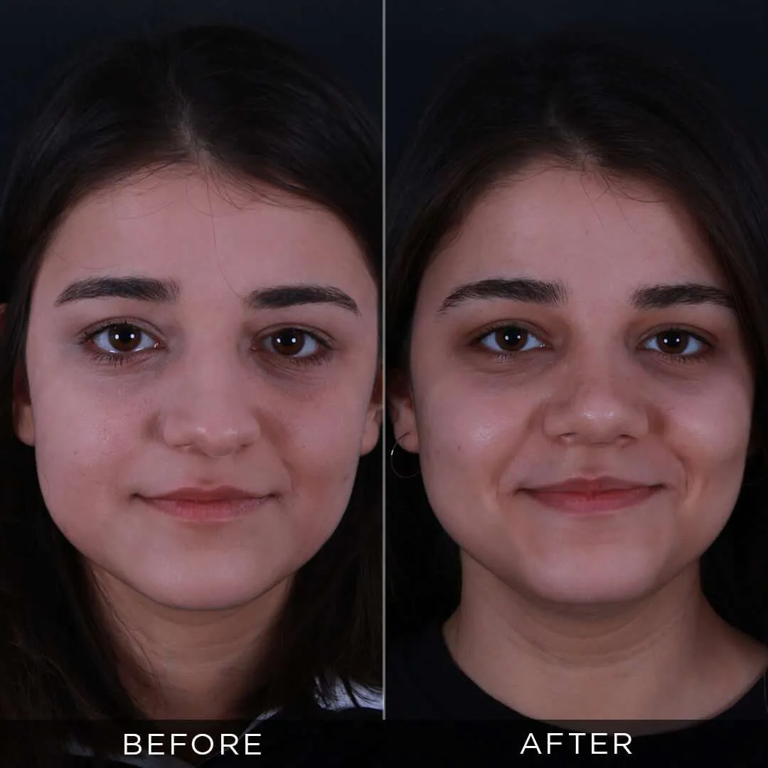 6 months after rhinoplasty at the age of 20