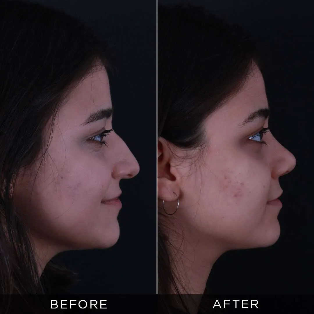 20 year old female piezzo rhinoplasty